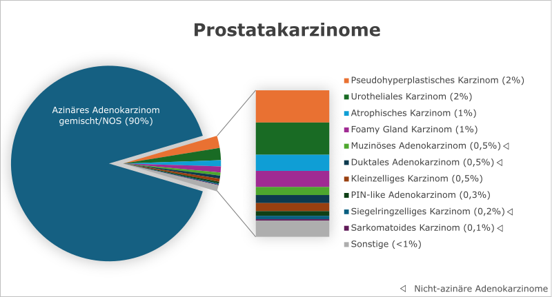 Azinäres Adenokarzinom Der Prostata Behandlung patho-logisch.de